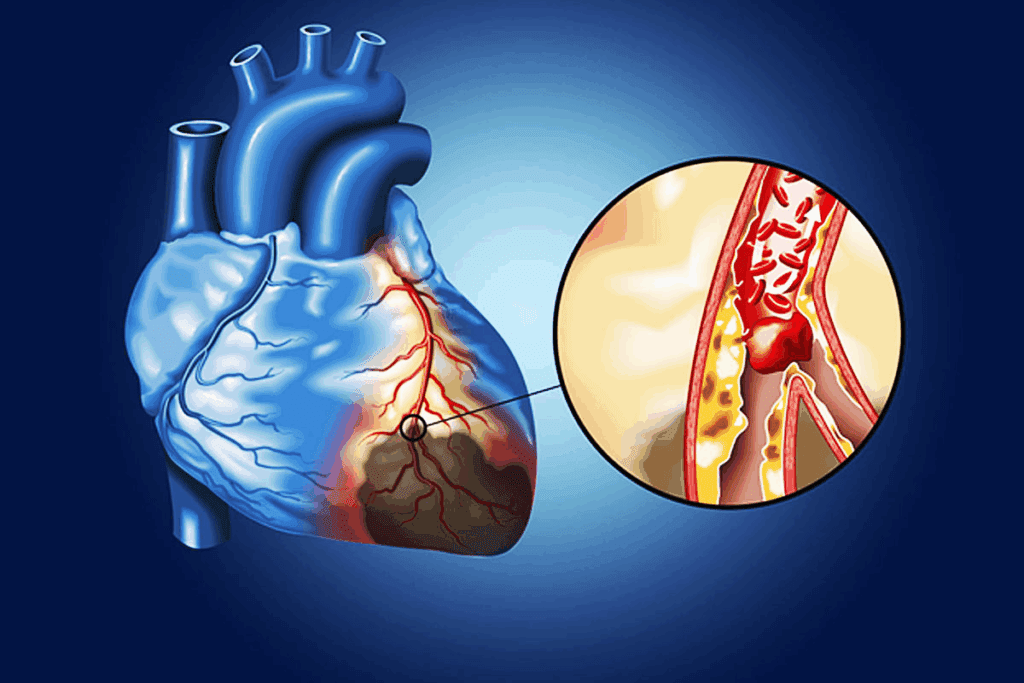 Heart Block Disease: Types, Symptoms & Causes 3 Heart Block Disease: Types, Symptoms & Causes