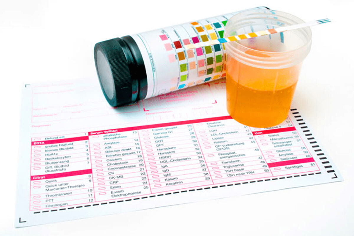 Urinalysis Results: Crucial Kidney Failure Indicators