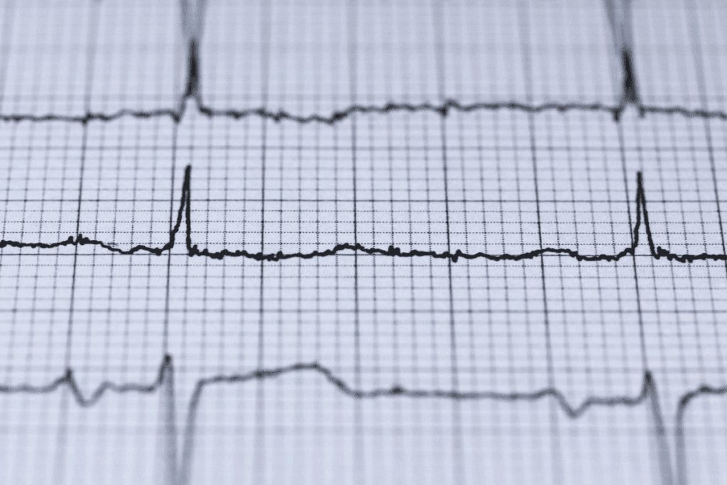 Complete Block ECG: 7 Key Findings