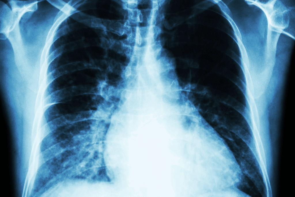 Can You Die From an Enlarged Heart? Risks & Facts