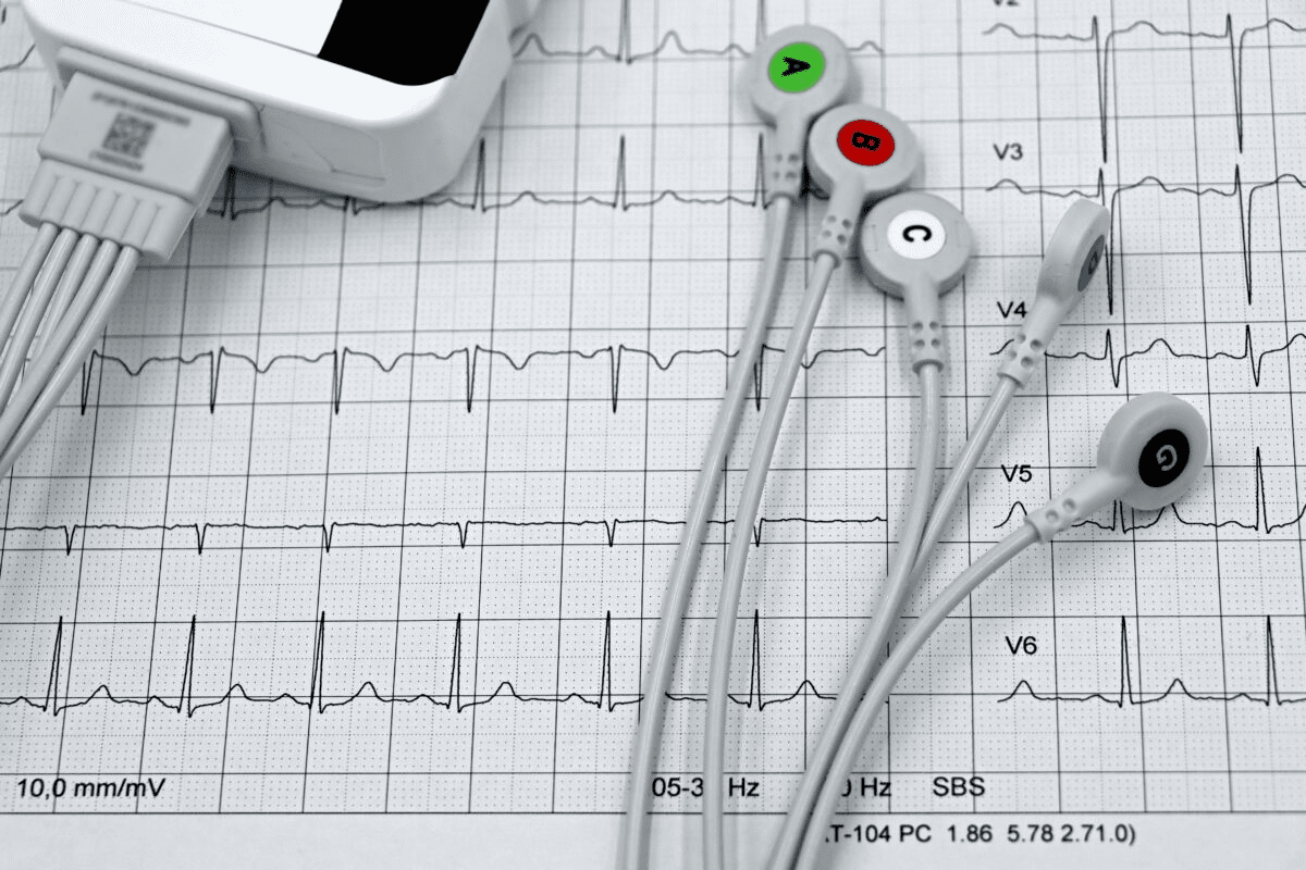 12 Lead Cardiogram: Heart Diagnosis Explained