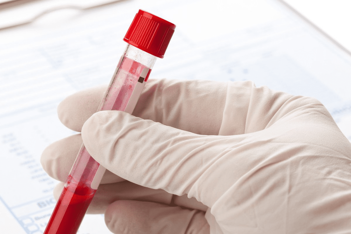 What Blood Test Shows Heart Failure? Explained