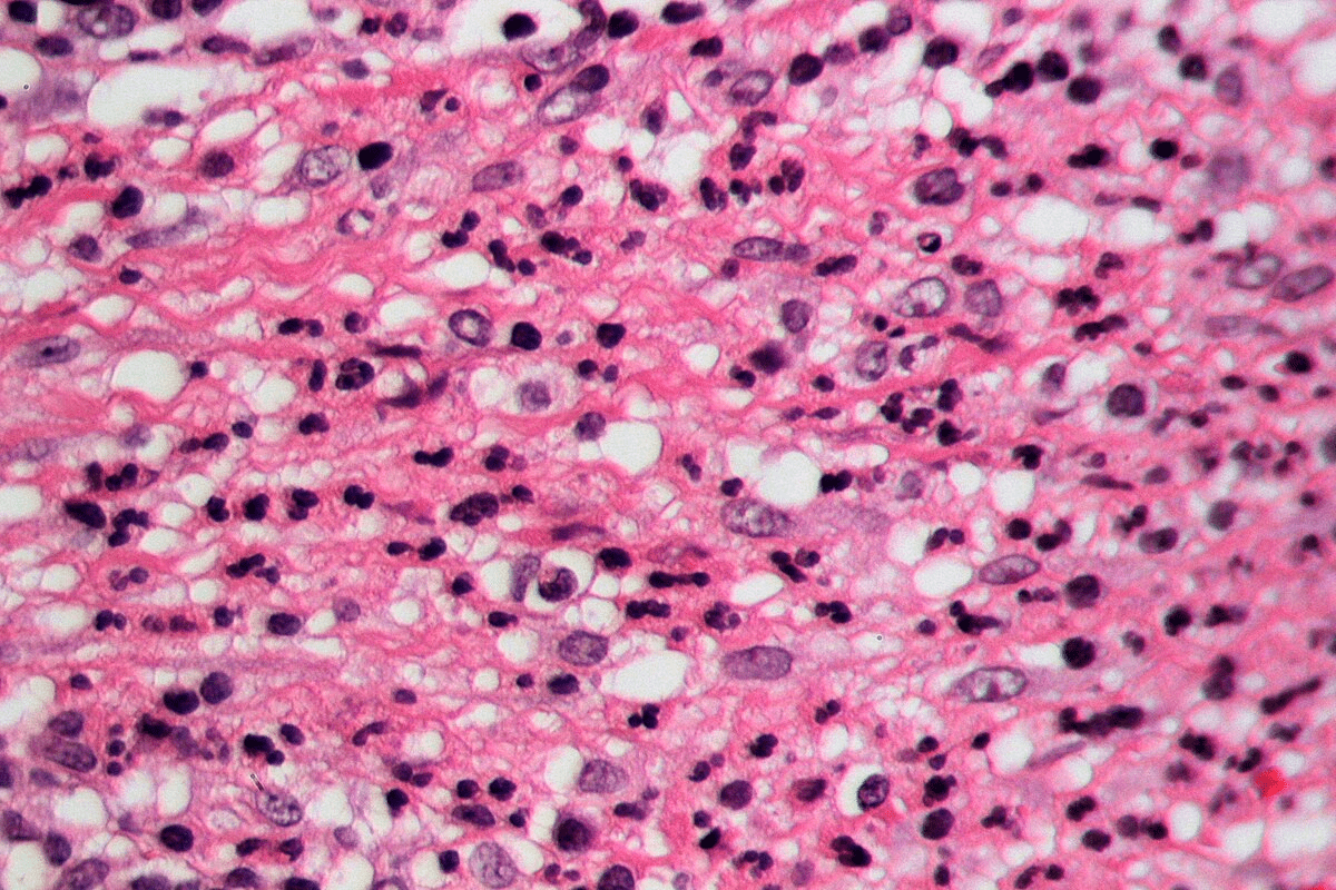 Abscess on Tonsil: Causes, Symptoms & Treatment