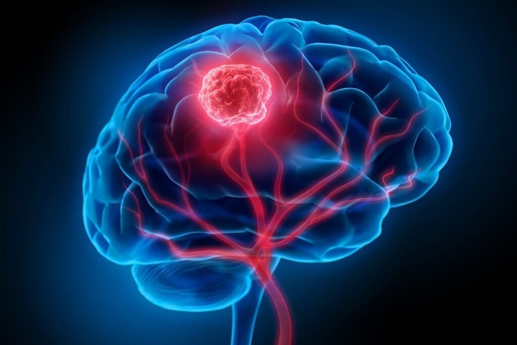 Glioblastoma Vs Neuroblastoma: Key Differences Explained