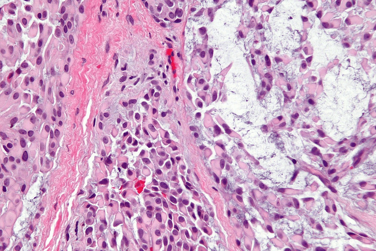 Do Squamous Cells in Urine Mean Cancer? Explained