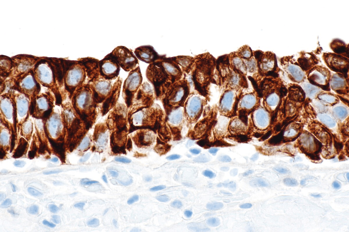Bladder Cancer Mortality Rate: Prognosis & Cure Rate