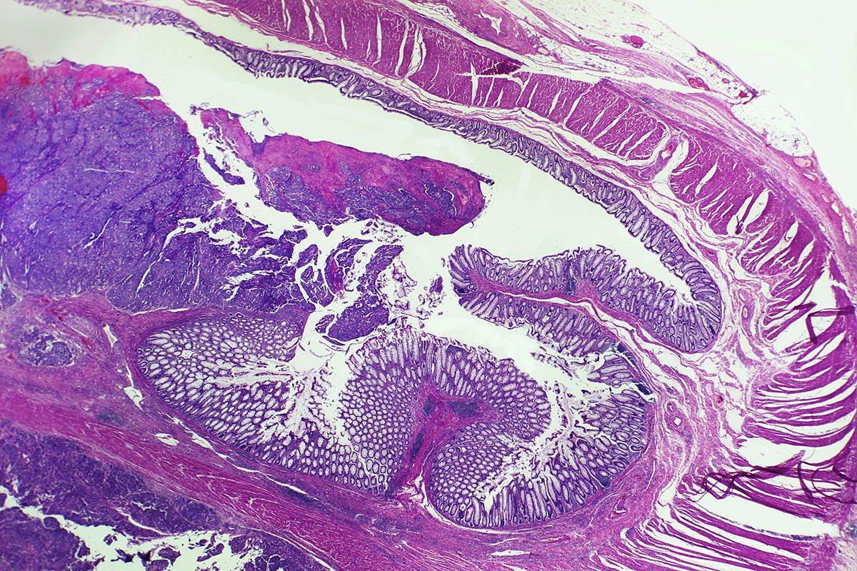 Prognosis Bladder Cancer That Has Spread: Metastatic Insights