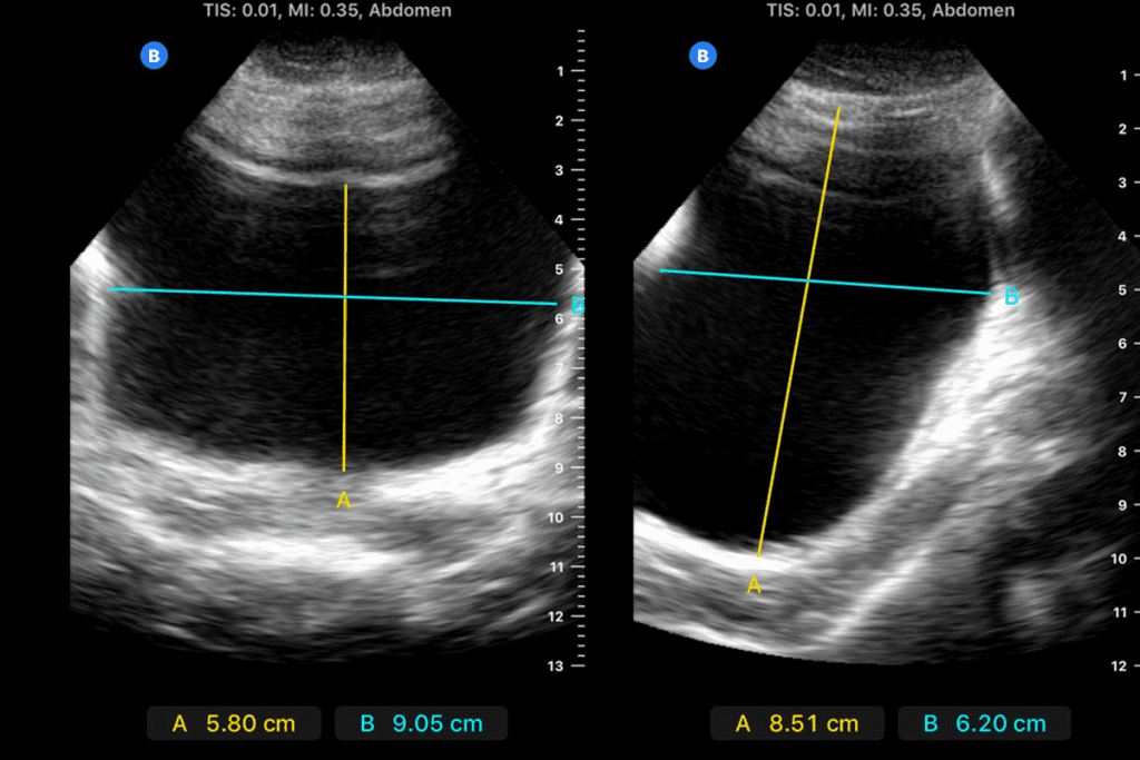 Conditions a Uroflow Test Detects & Normal Urine Output in One Hour