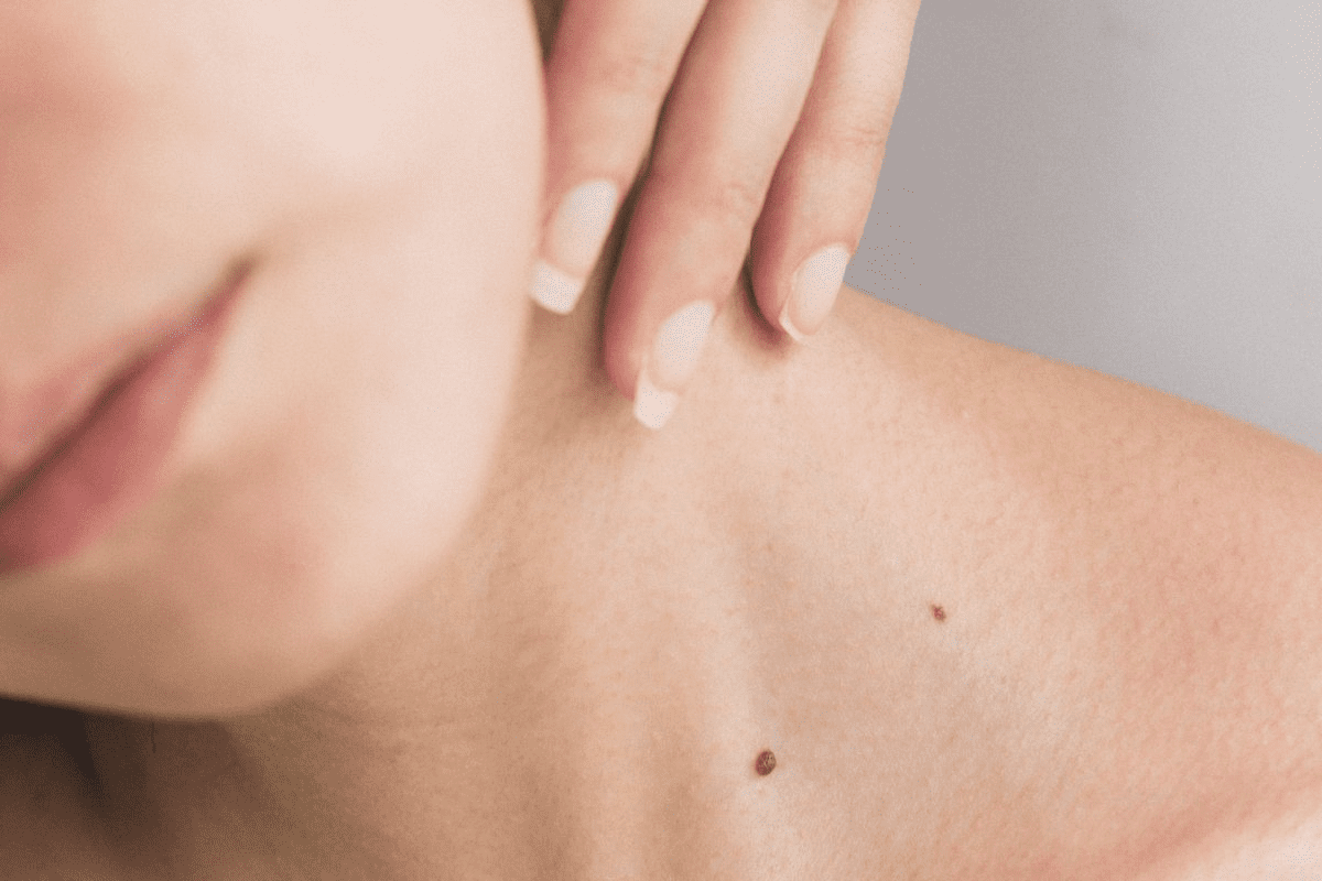 TNBC of the Skin: What Do Skin Cancer Lesions Look Like?