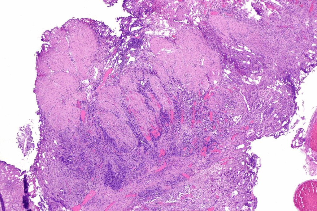 Urinary Bladder Cancer Prevention: Key Risk Factors