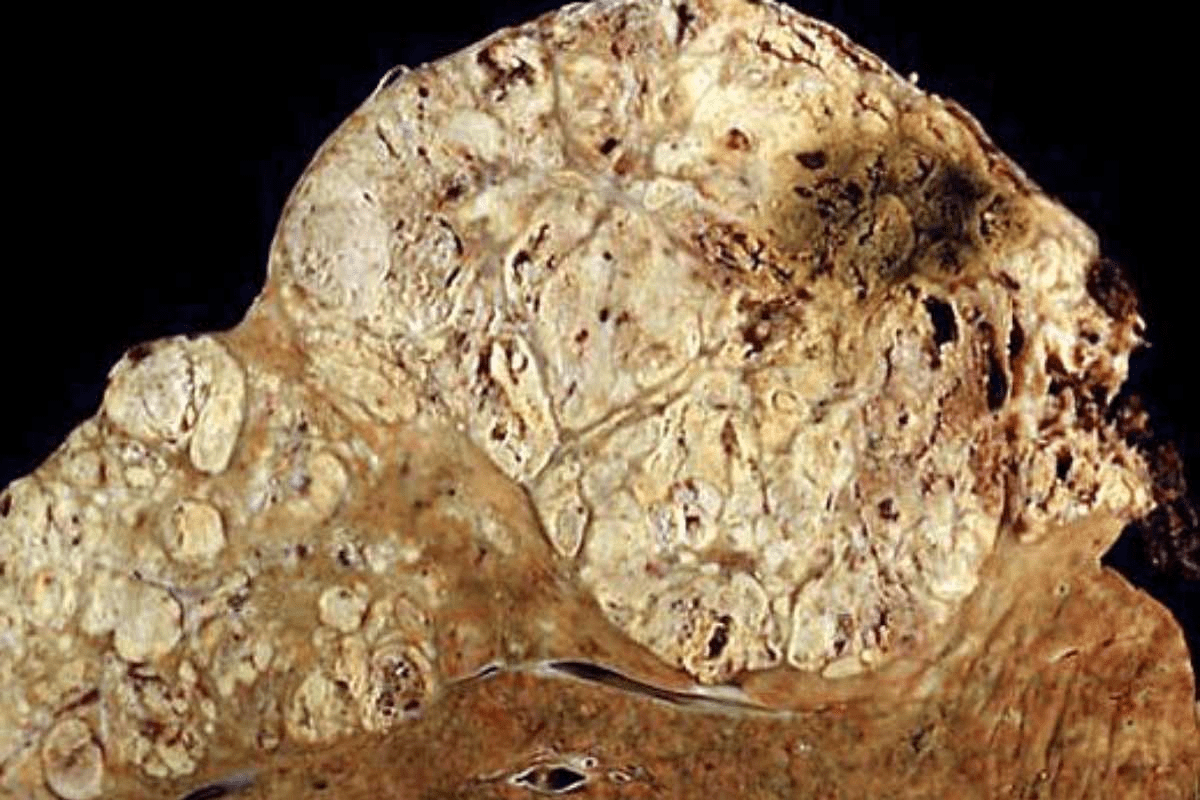 Basal Cell Carcinoma on Scalp: Treatment