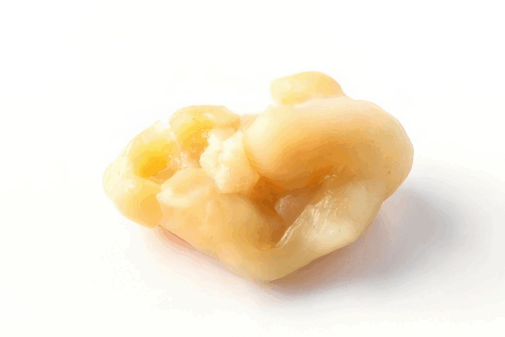 Age Limit for Tonsillectomy: Full Guide