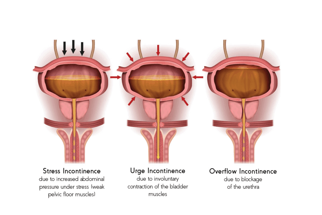 Exercises for Bladder Incontinence: 7 Control Methods