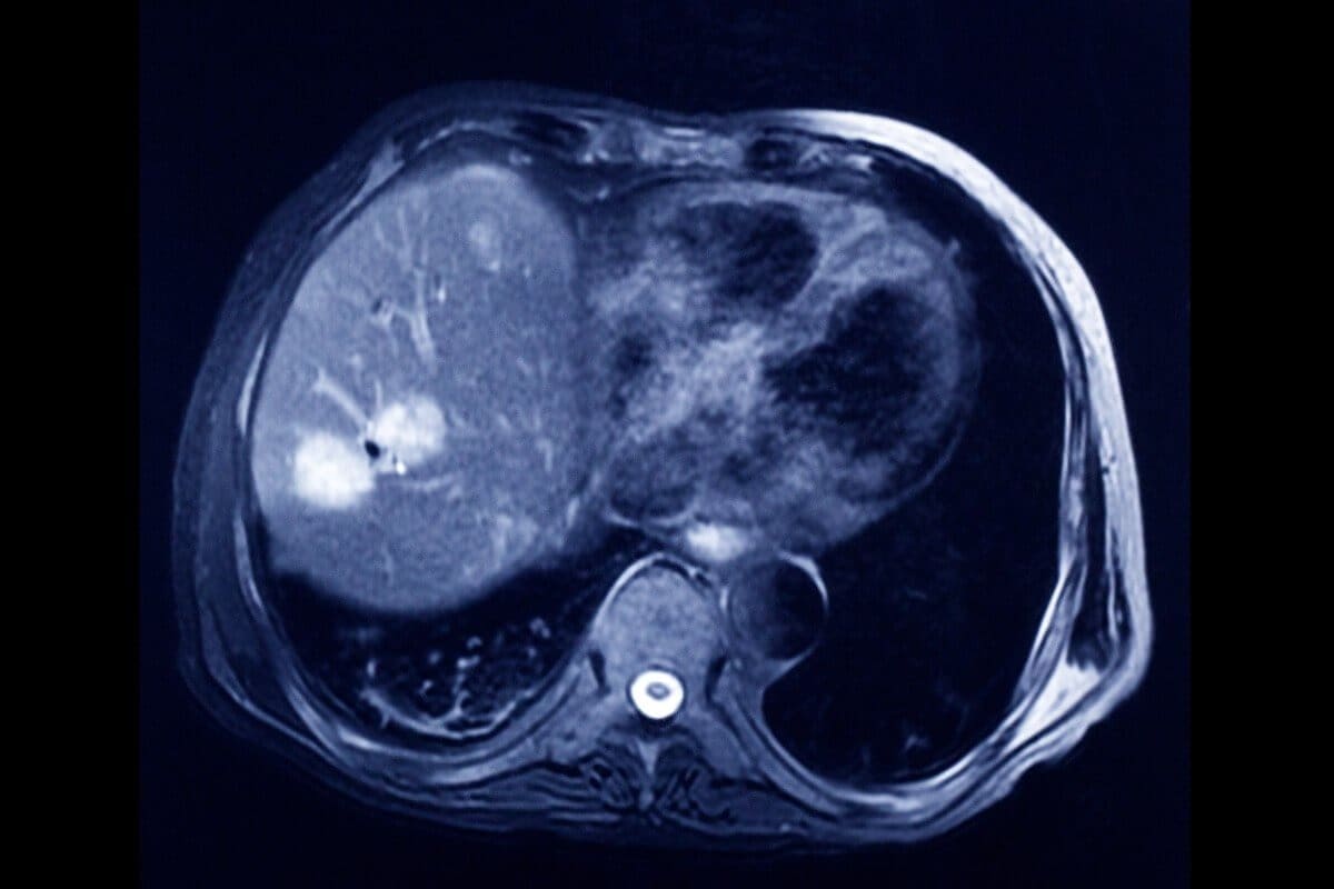 Yes: Does a CT Scan Detect Tumors in the Bladder?