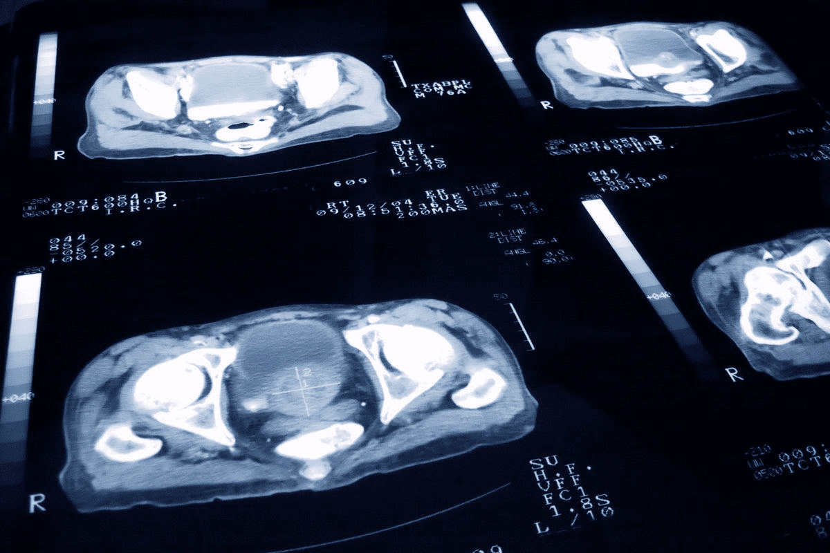 Prostate MRI: When Do You Really Need It?