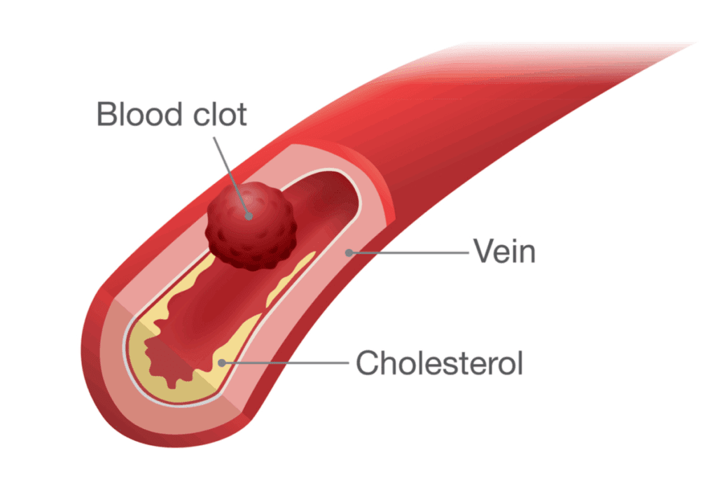 UTI and Blood Clots: Causes and When to Worry