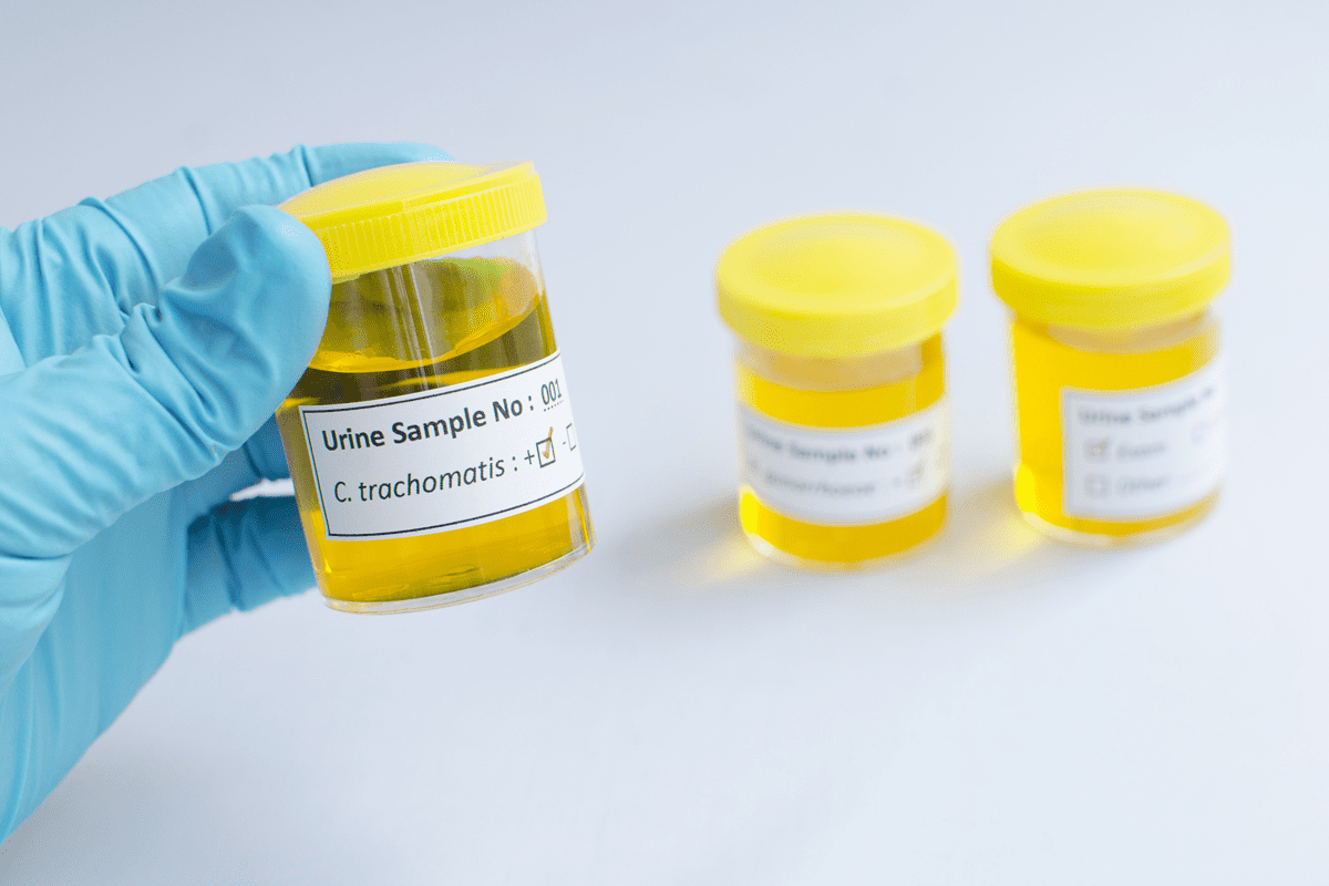 UTI Test: Crucial Normal Bacteria Count