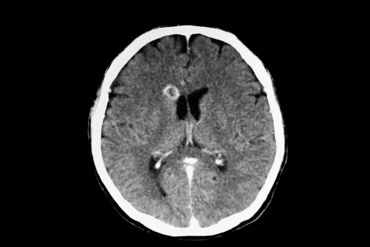What causes lesions on the brain? Explore the causes, from infection and MS to tumors, and which types can potentially go away.