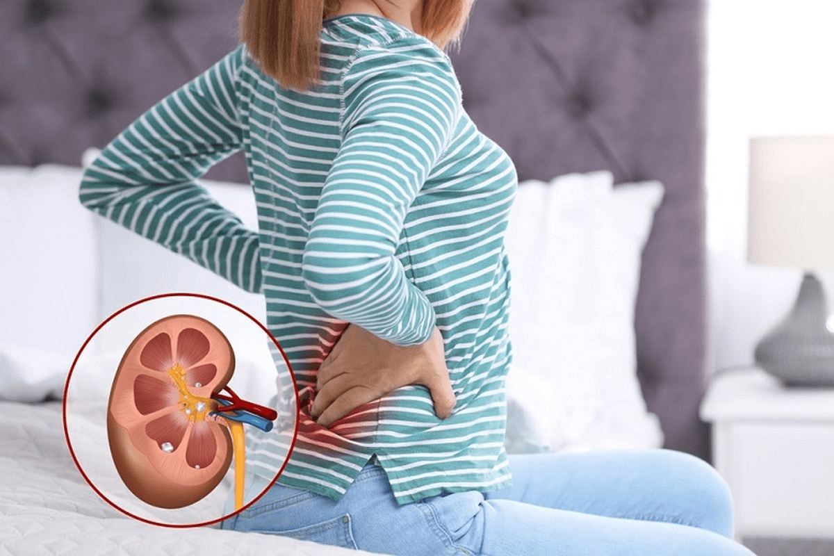 Can Kidney Stones Cause Blood in Urine Without Pain?