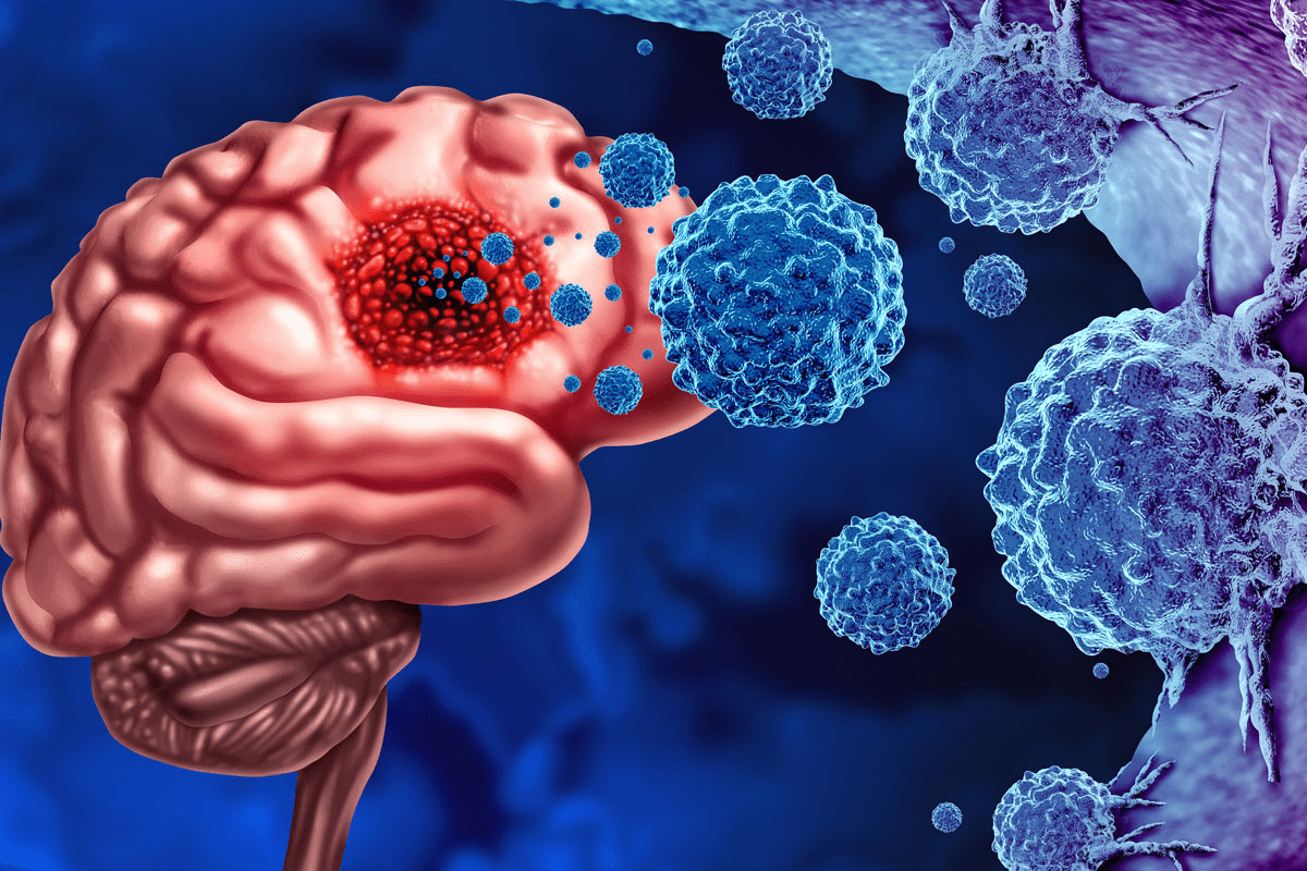 What are the key brain metastases symptoms? Learn the warning signs that indicate cancer may have spread to the brain.