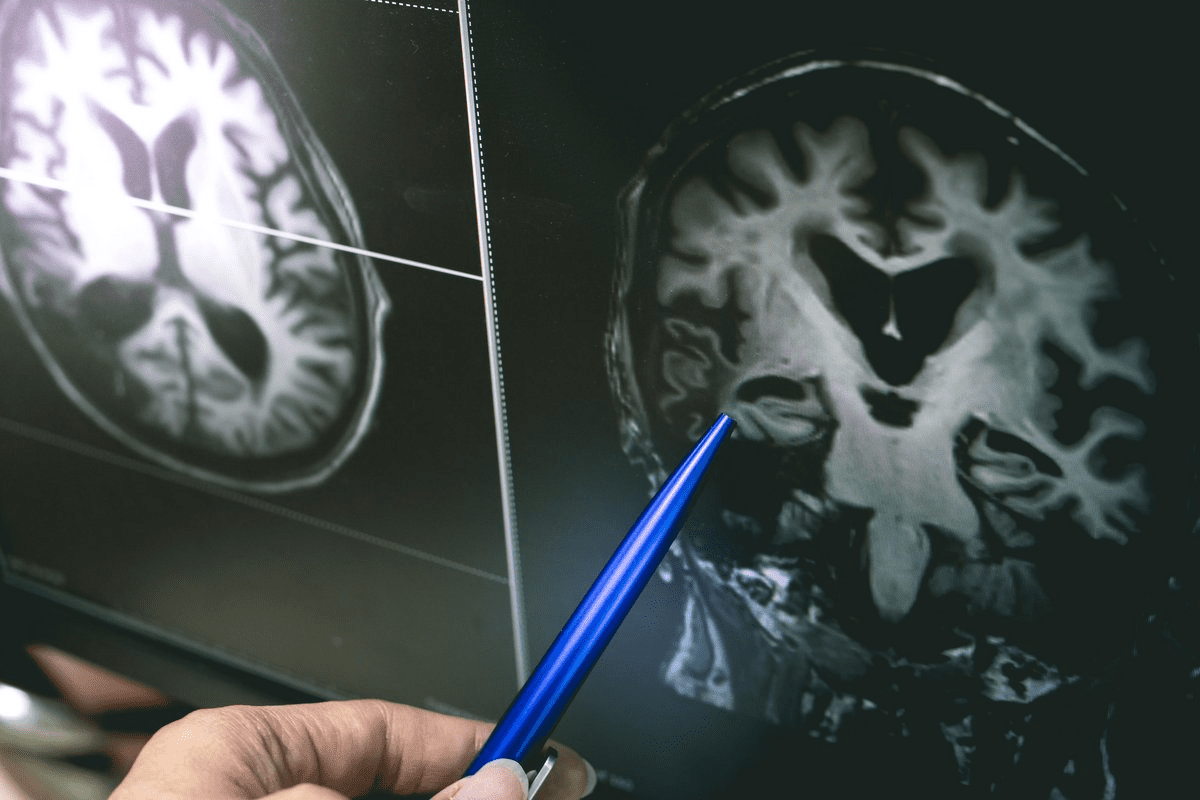 Metastatic brain cancer: Learn about the speed of spread, factors affecting growth rate, and the importance of timely treatment.