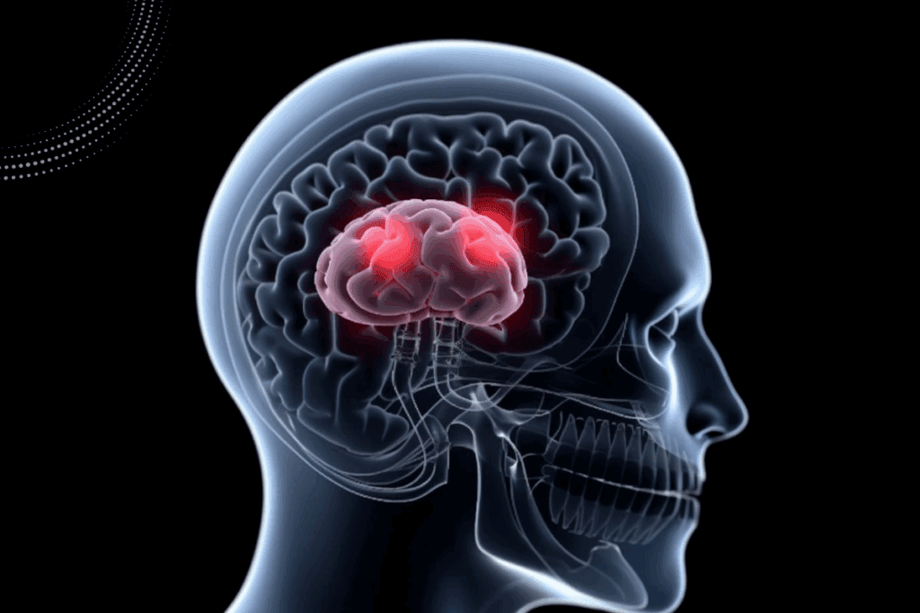 Lung Cancer Mets to Brain: Key Facts