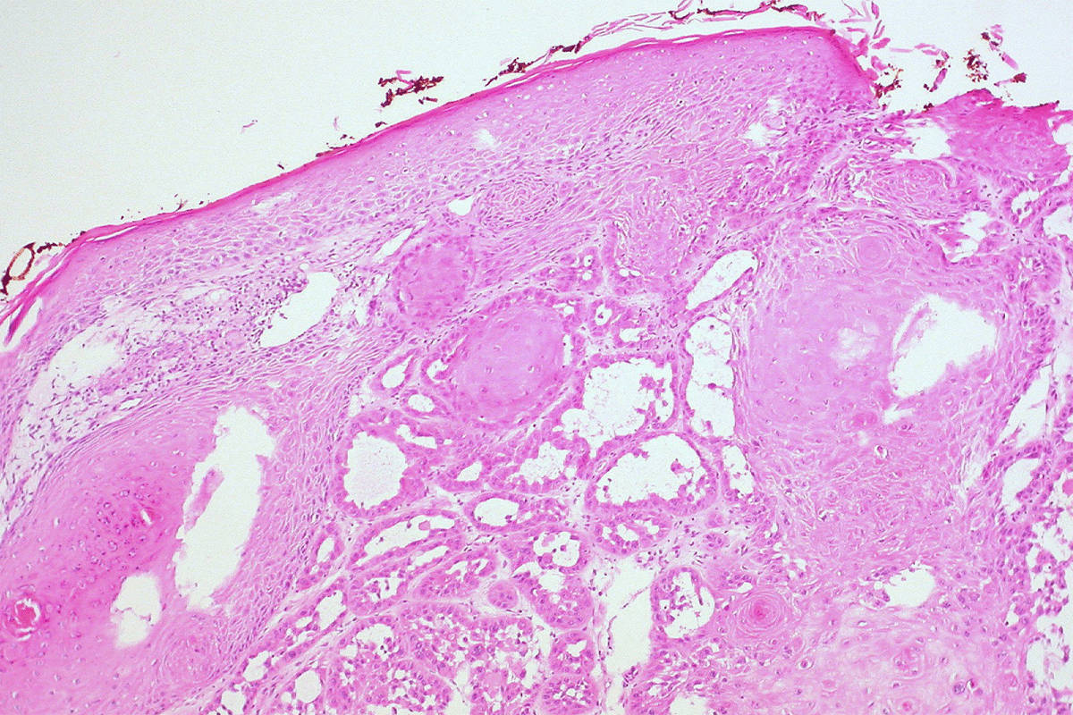 Carcinoma Symptoms: Early Warning Signs
