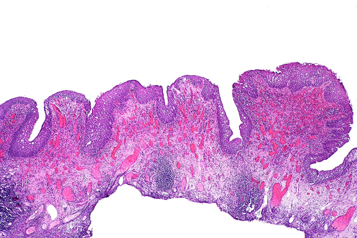 Can You Die From a Bladder Infection ?