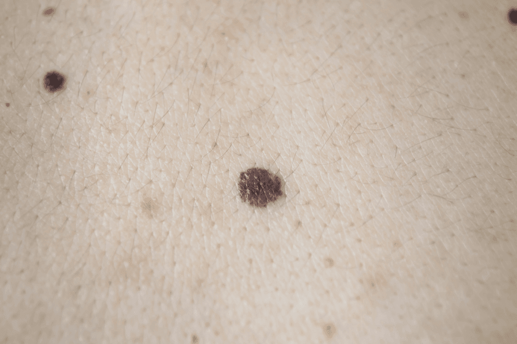 Melanoma on Scalp: Detection & Care