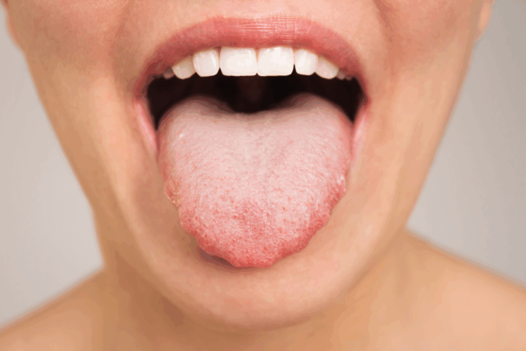 What Does Tongue Cancer Look Like?