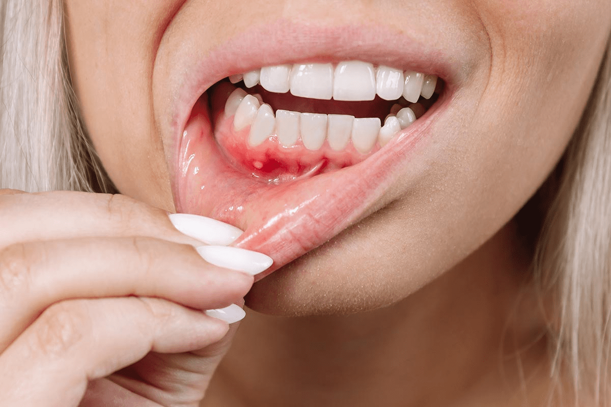 Early Under Tongue Cancer: Signs & Guide