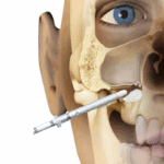 Is Acute Sinusitis Contagious?