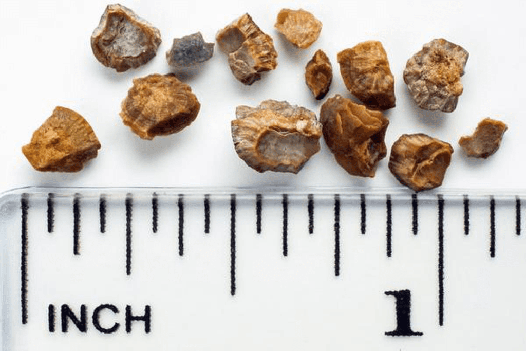 Kidney Stone Size: When is Surgery Absolutely Needed? 2 Kidney Stone Size: When is Surgery Absolutely Needed?