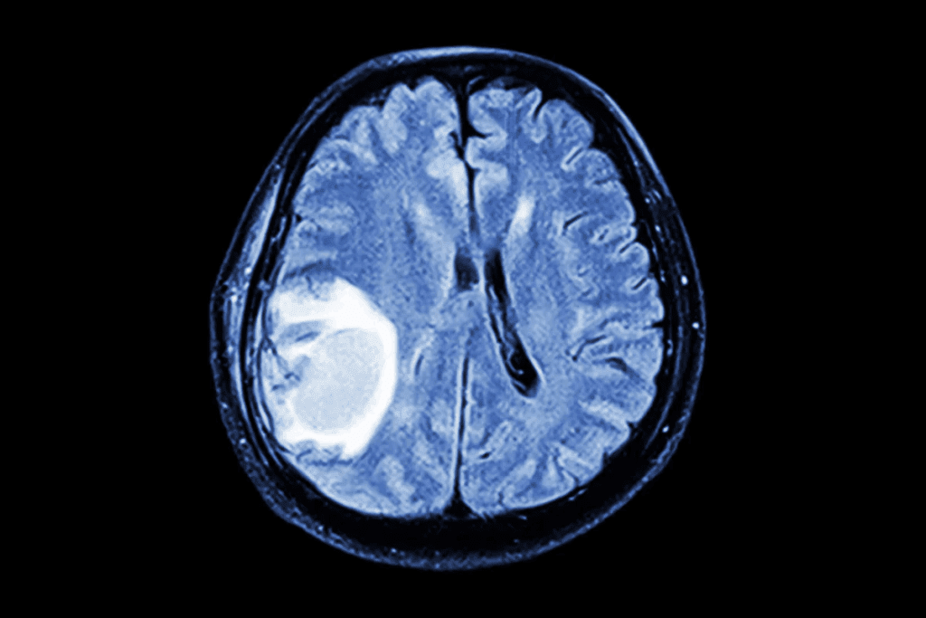 Metastatic Intracranial Tumors: Explained