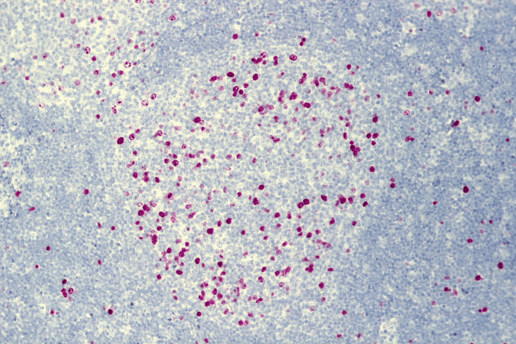 Symptoms of NHL: Early Signs to Watch