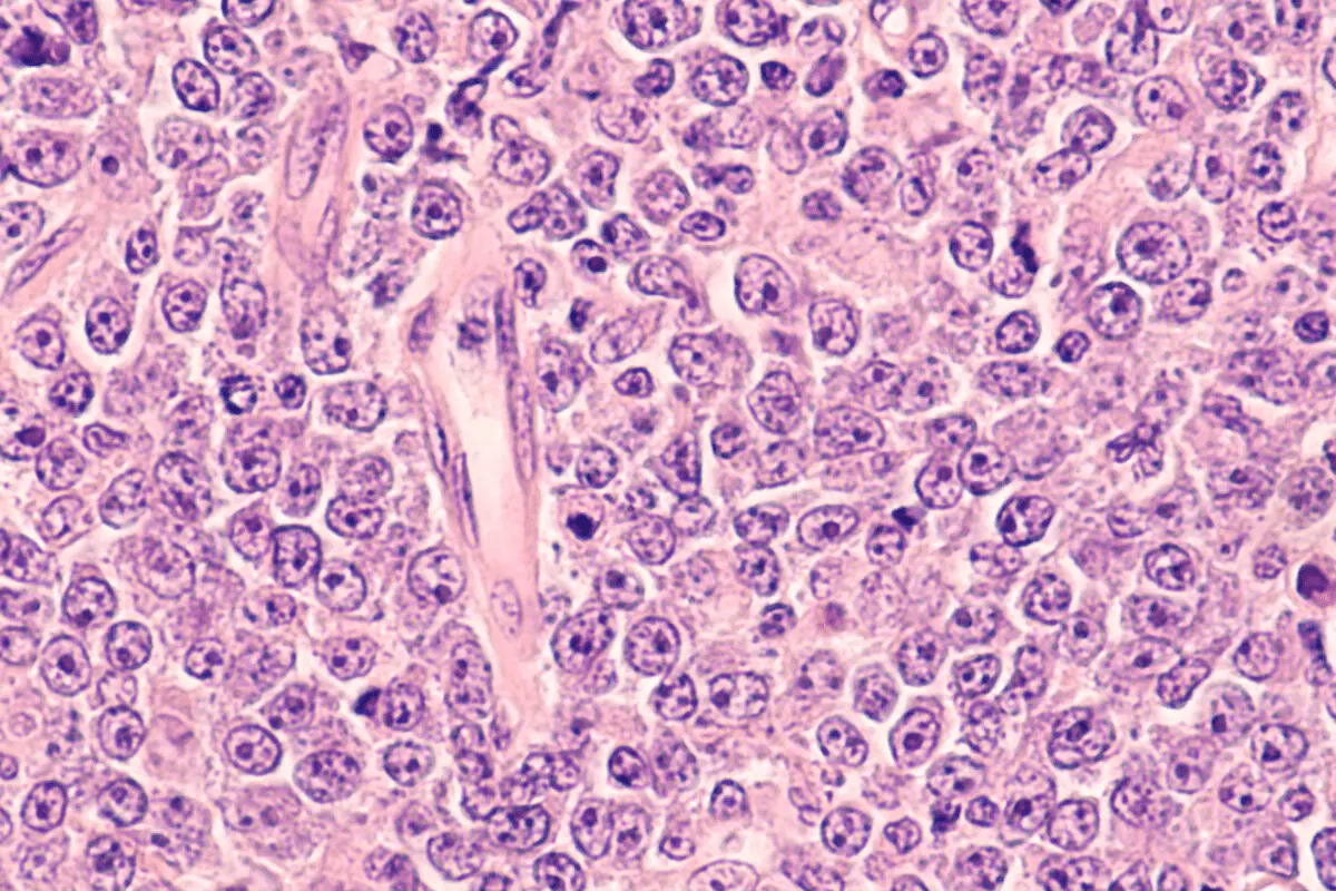 Symptom of Non Hodgkin Lymphoma: Early Signs