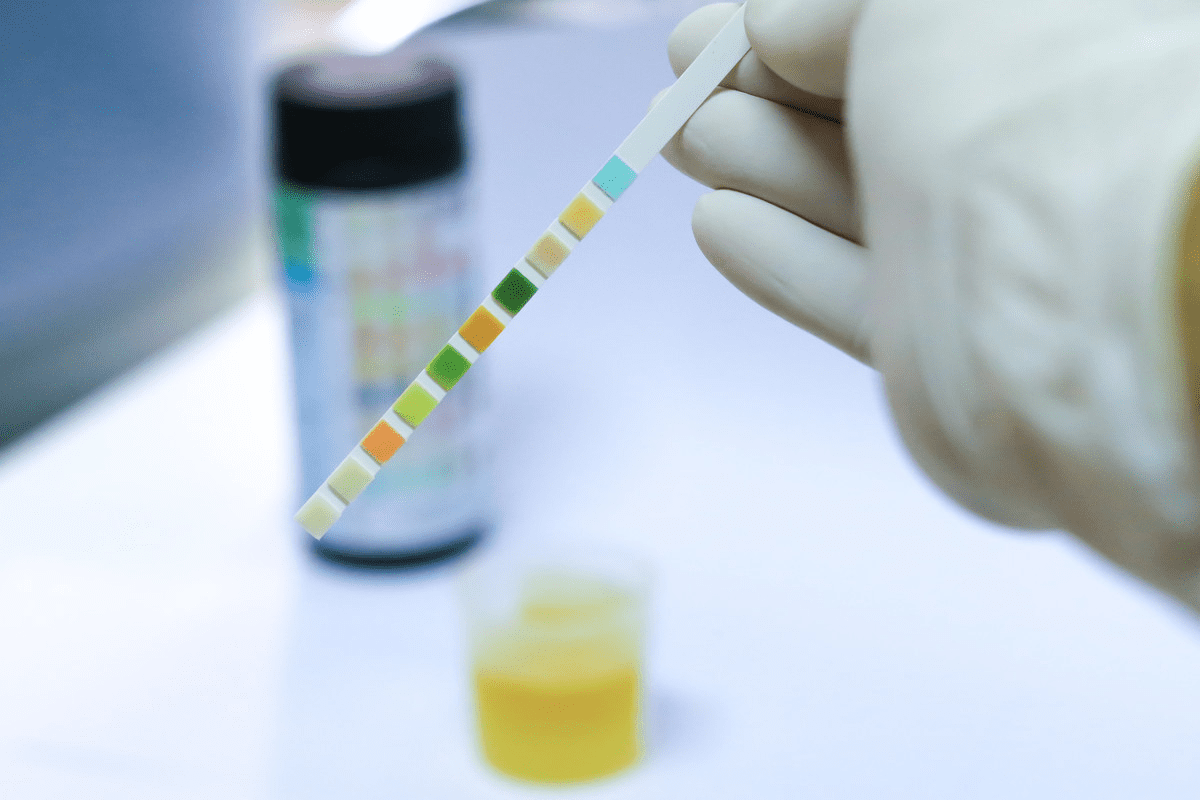 Urinalysis Results: Crucial Guide on How to Read