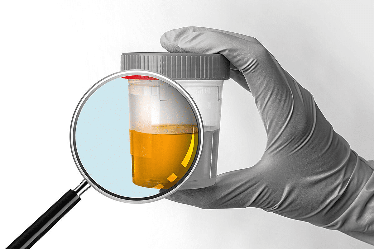 Many Bacteria in Urine: Causes & When to Worry