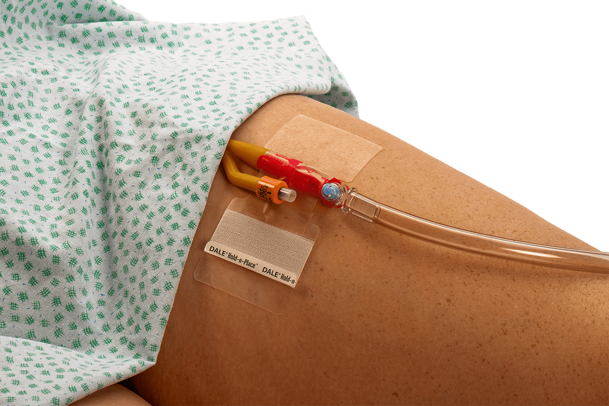 Suprapubic Catheterization: Crucial Reasons for Surgery