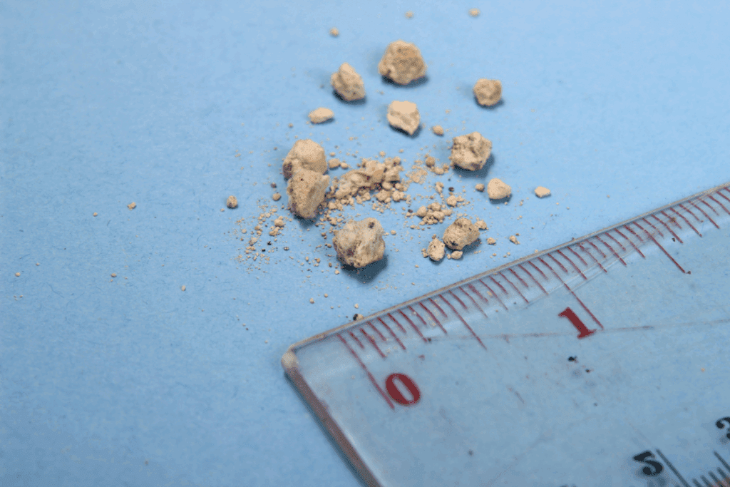 Cloudy Urine Kidney Stones: Causes & Treatment