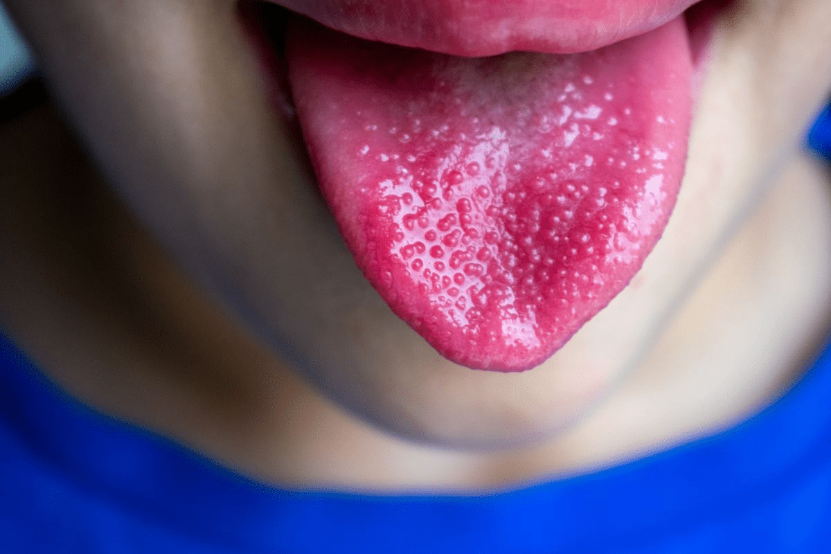 Bacterial Acute Pharyngitis Treatment Guide