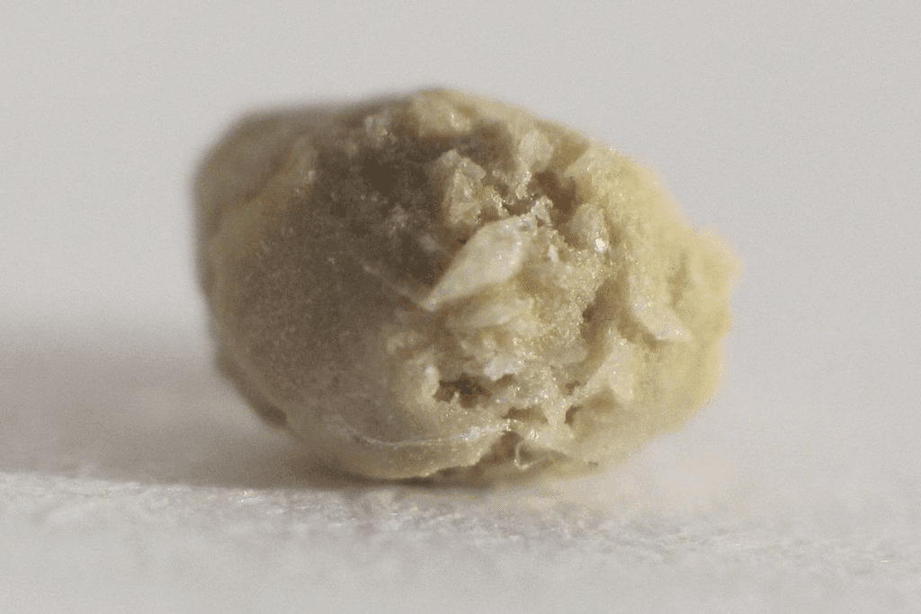 Black Kidney Stones in Urine: Prevention