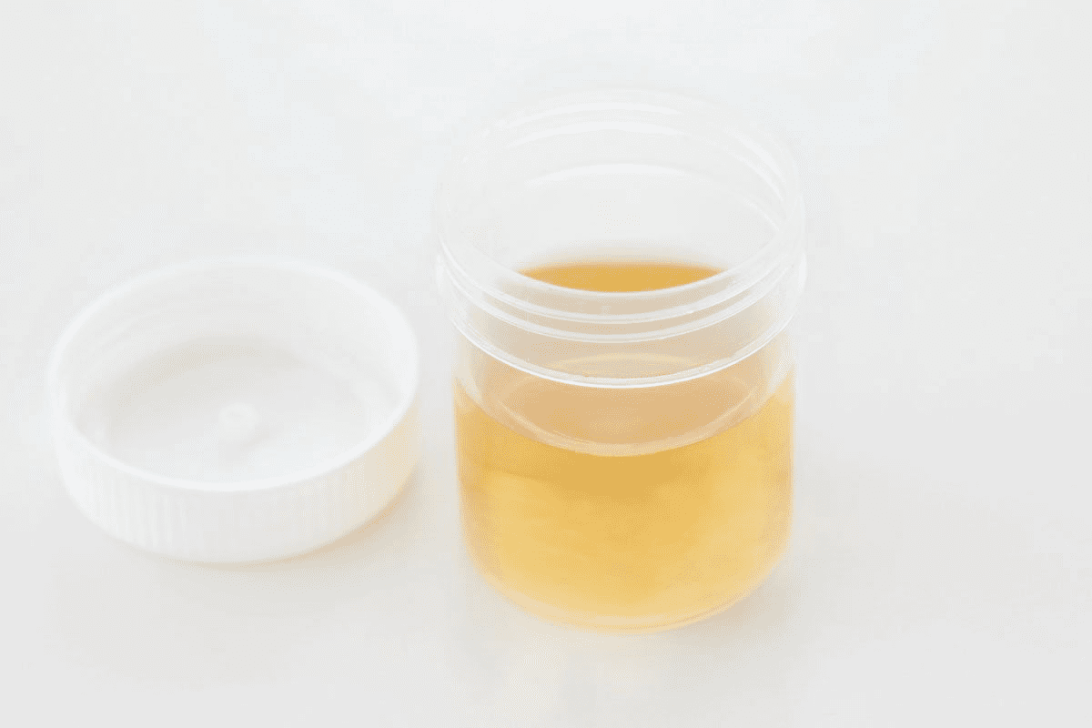 Signs of Crystals in Urine: Causes & Range