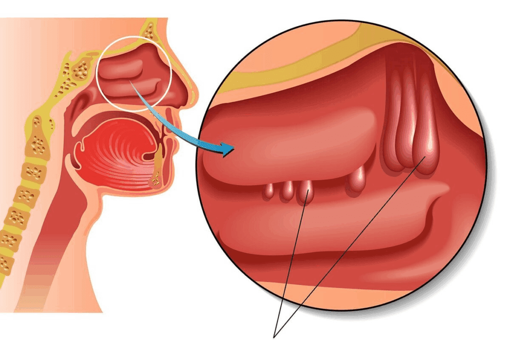 Dry Sinus Infection: Relief for Symptoms