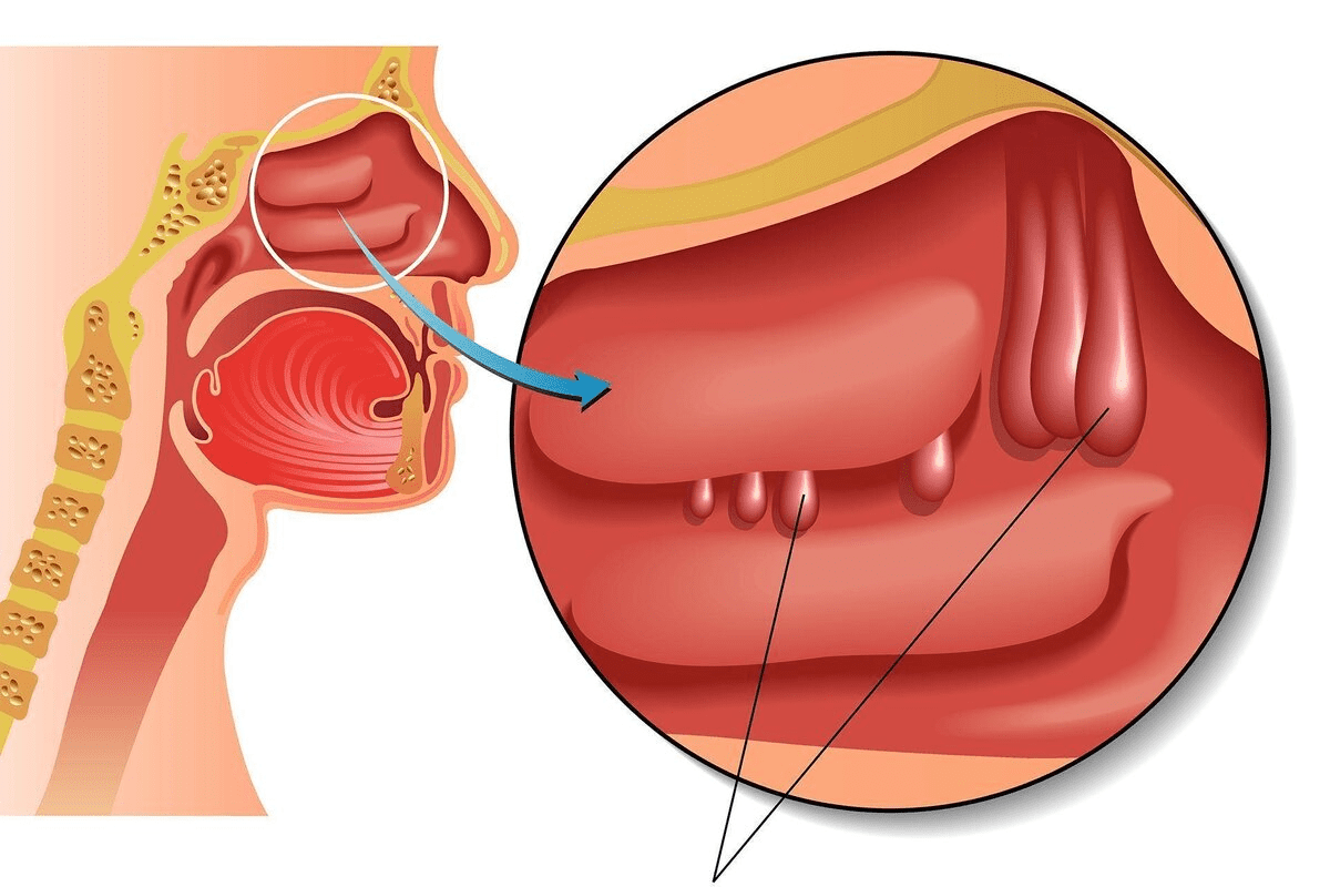 Dry Sinus Infection: Relief for Symptoms