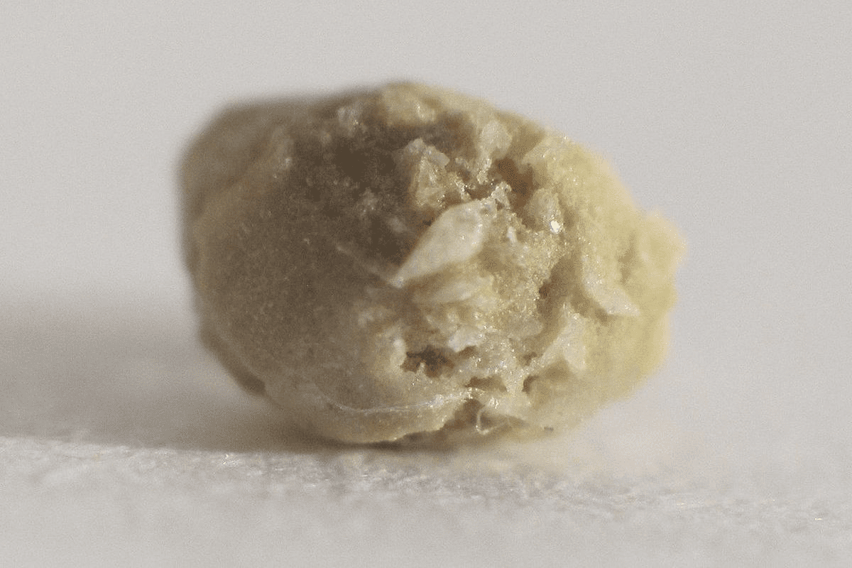 What Does a Bladder Stone Feel Like? Symptoms in Women