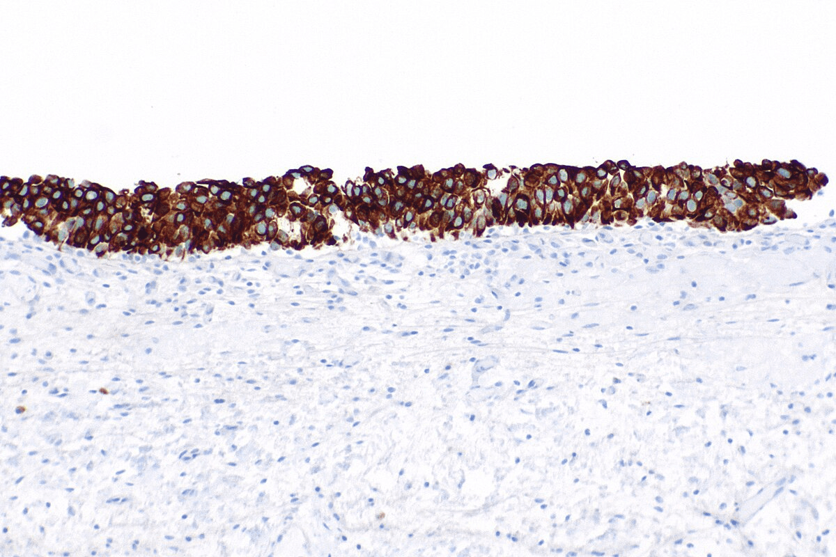 Urothelial Carcinoma in Situ: Pathology Guide