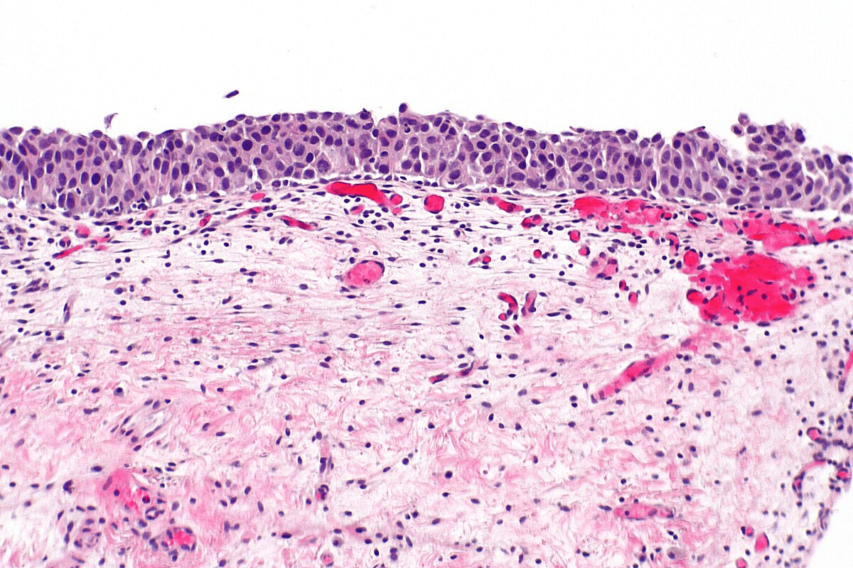 Cancer in Situ Meaning and Explanation
