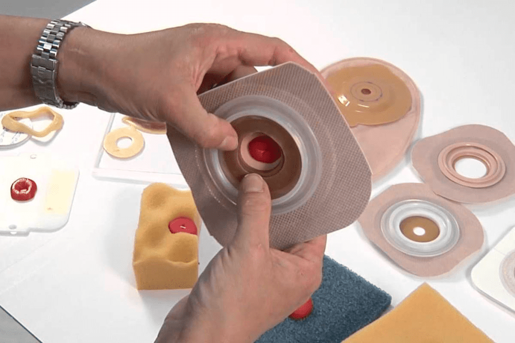 Urostomy Care: Does the Pouch Truly Smell? Positive