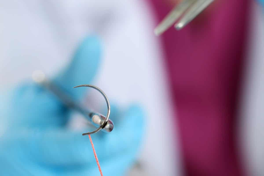 Meatus Urethral Stricture: The Amazing New Treatment 3 Meatus Urethral Stricture: The Amazing New Treatment